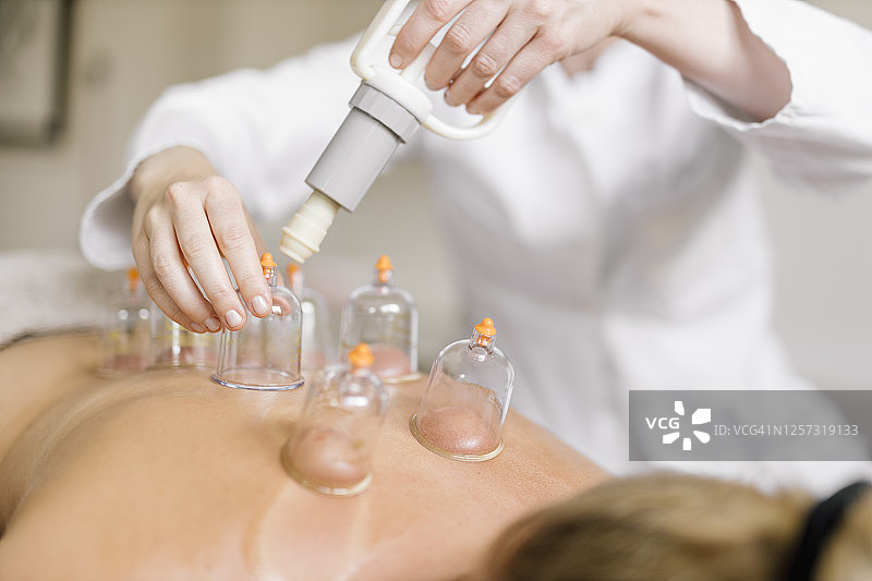 背部拔罐疗法图片素材