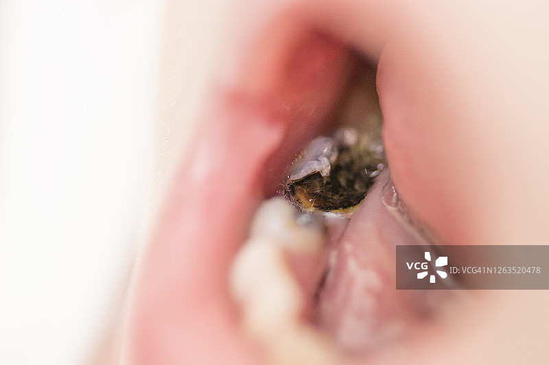 儿童张开嘴巴，显示蛀牙图片素材