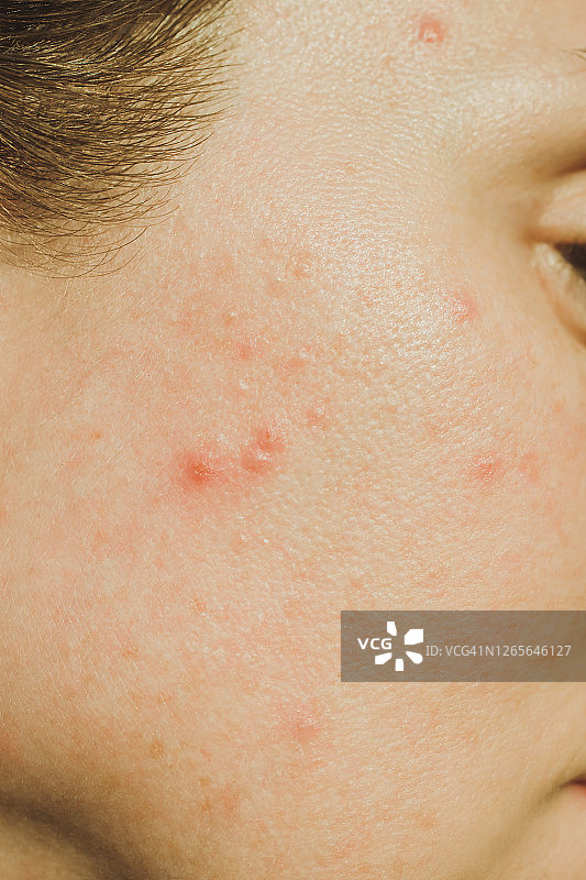 成人痤疮特写图片素材