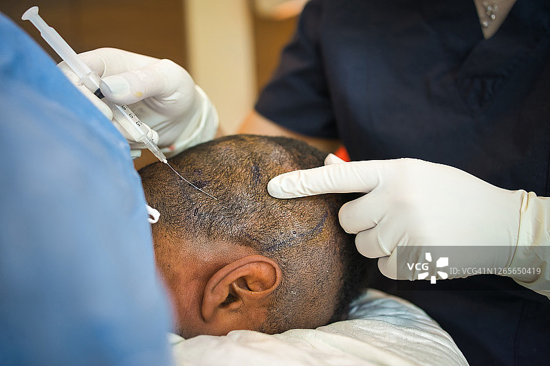 毛发移植图片素材