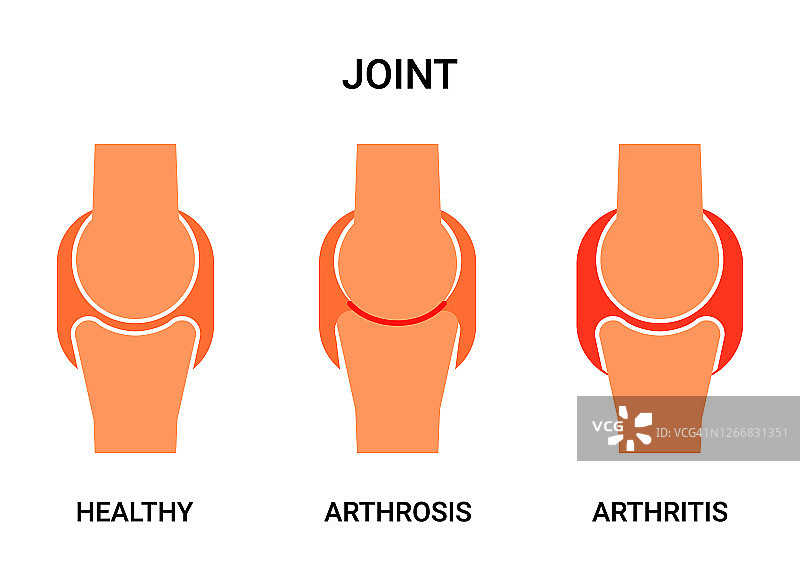 人体关节健康、关节炎和关节病矢量图图片素材
