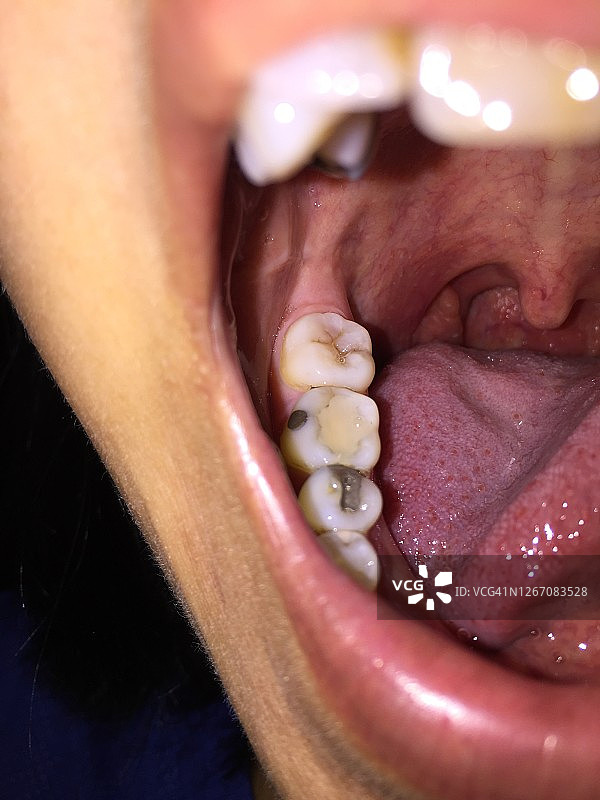 扁桃体炎感染咽喉图片素材