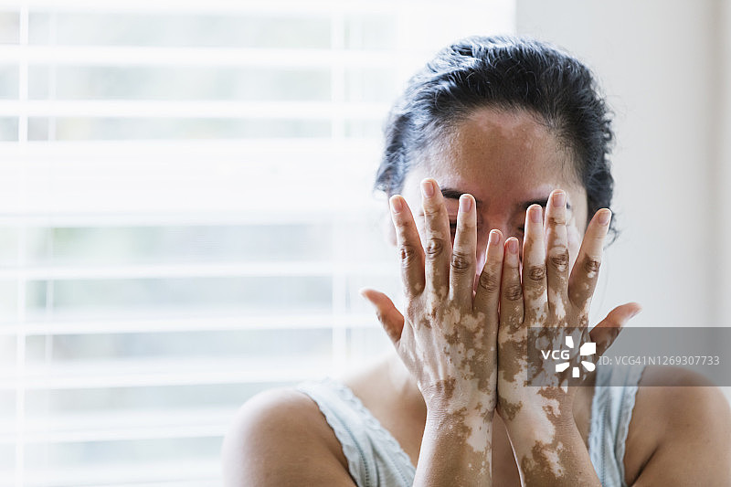 患有白癜风的中年混血女人图片素材
