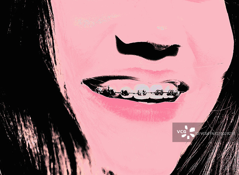 戴牙套的女孩图片素材