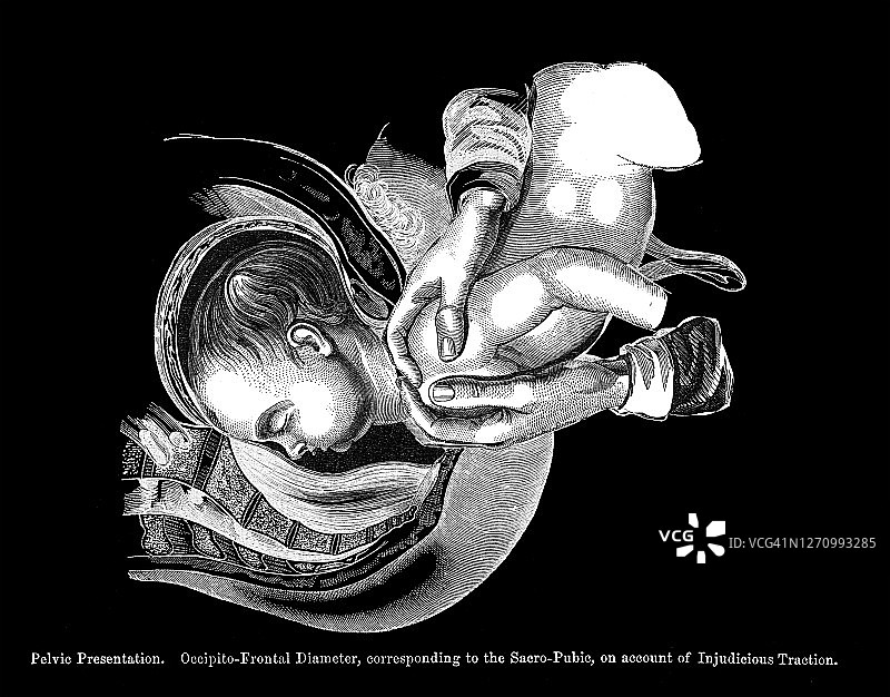 子宫内胎儿不同位置的古老雕刻插图图片素材