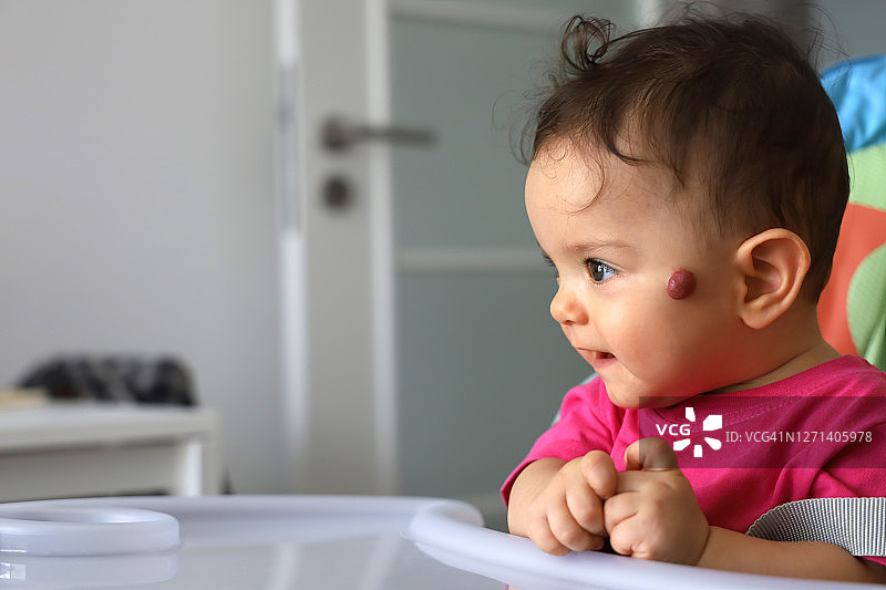 婴儿面部的血管瘤图片素材