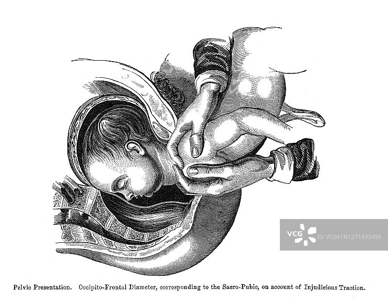 子宫内胎儿不同位置的古老雕刻插图图片素材