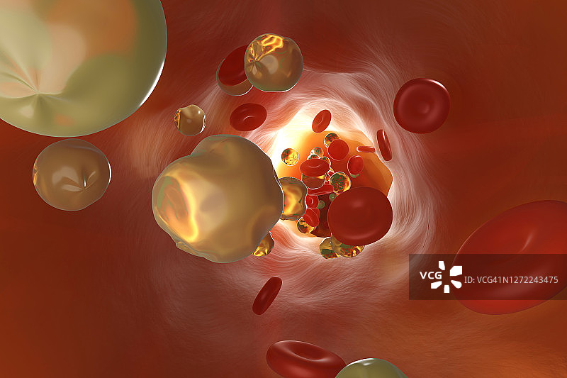 被胆固醇堵塞的动脉的三维渲染图图片素材