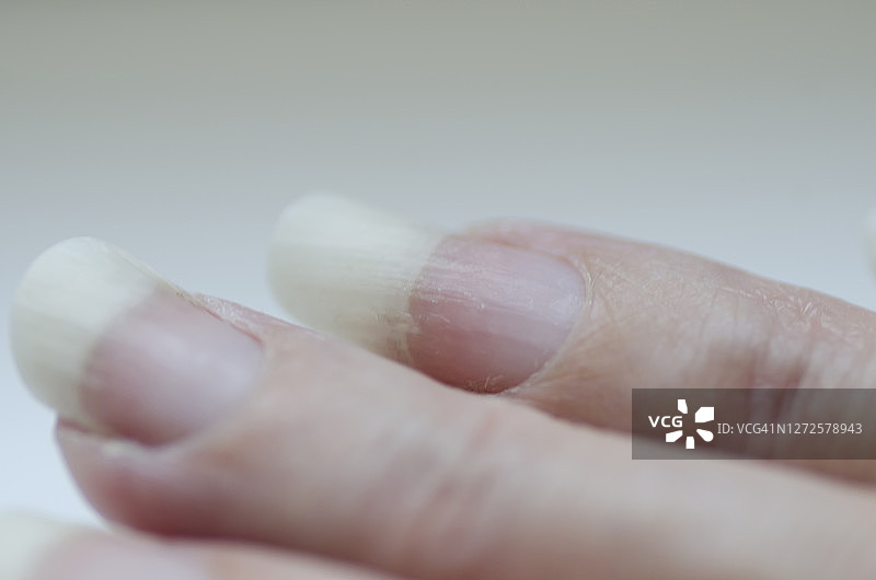 脆弱的指甲特写。使用抛光剂后指甲受损。指甲脱落。指甲损伤。碎裂的指甲图片素材