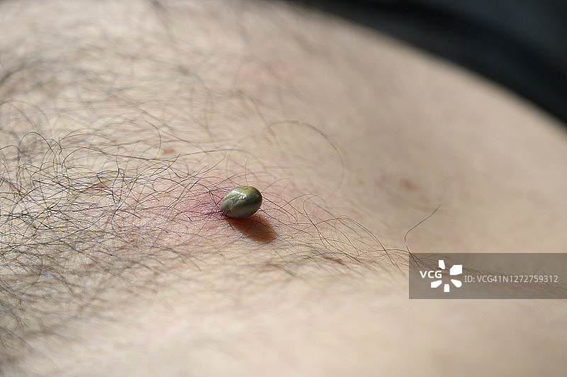 附着在男人腹部皮肤上吸血的蜱虫。德国图片素材