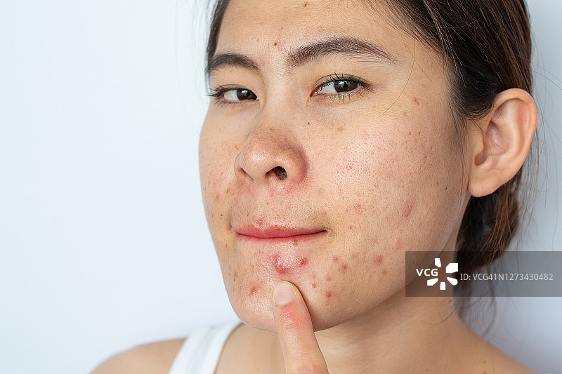 面部有痤疮炎症（丘疹和脓疱）和疤痕问题的亚洲女性肖像图片素材