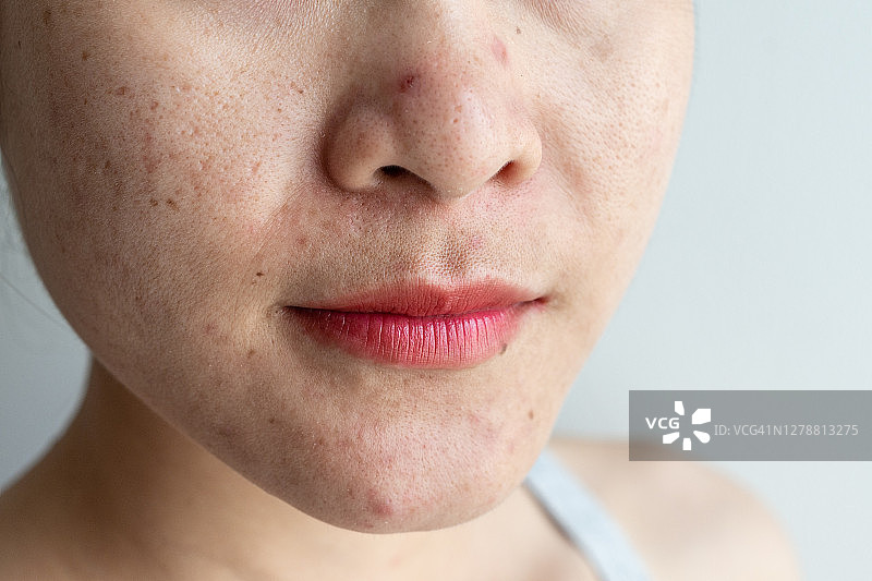 面部痤疮发炎的女性特写图片素材