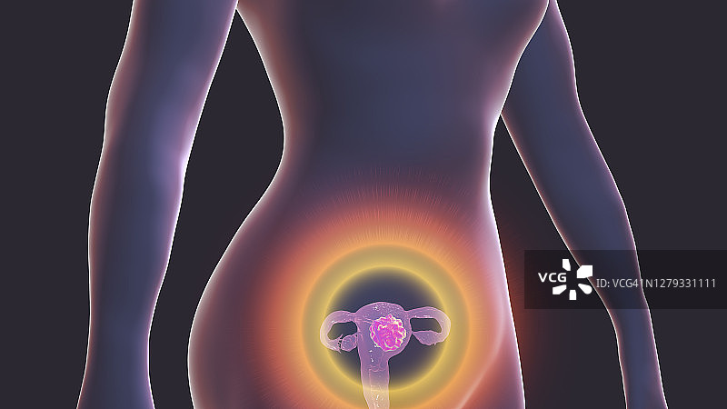 子宫癌概念图图片素材