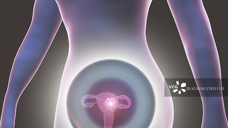 子宫癌概念图图片素材
