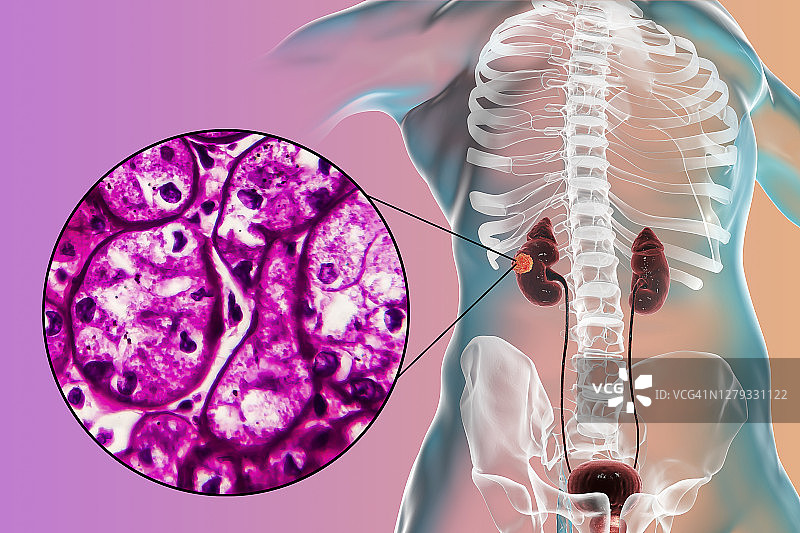 肾癌插图与显微照片图片素材