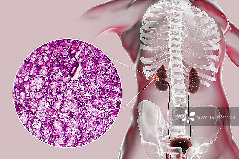 肾癌插图与显微照片图片素材