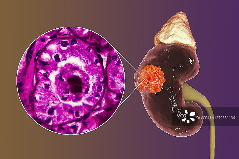肾癌插图与显微照片图片素材