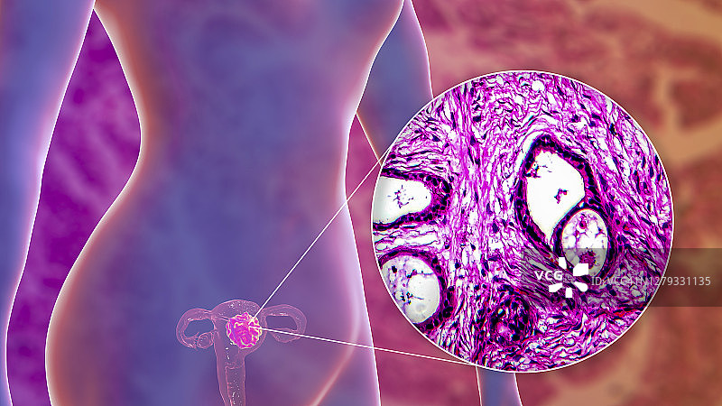 子宫癌插图和光学显微照片图片素材