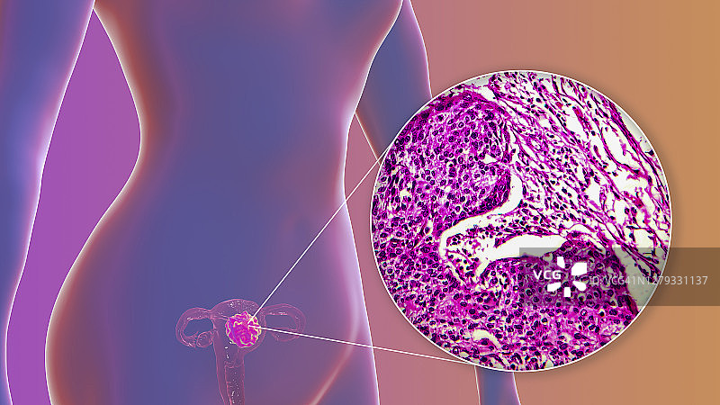 子宫癌插图和光学显微照片图片素材