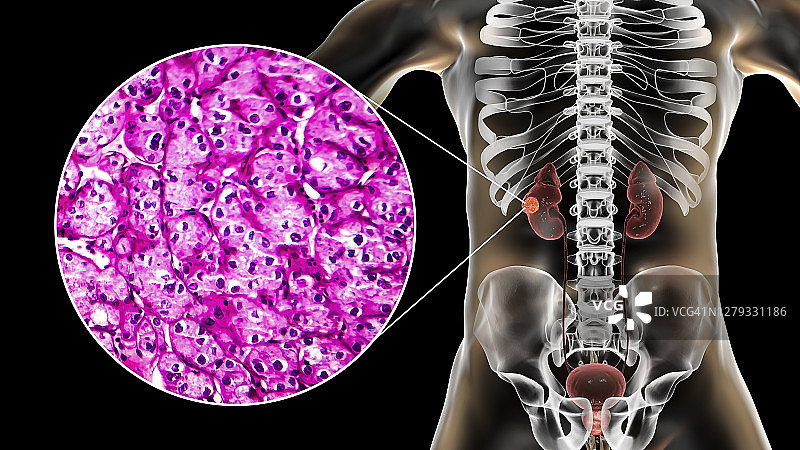 肾癌插图与显微照片图片素材