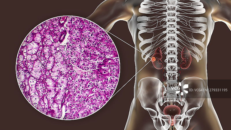 肾癌插图与显微照片图片素材