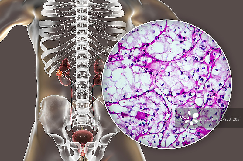 肾癌插图与显微照片图片素材