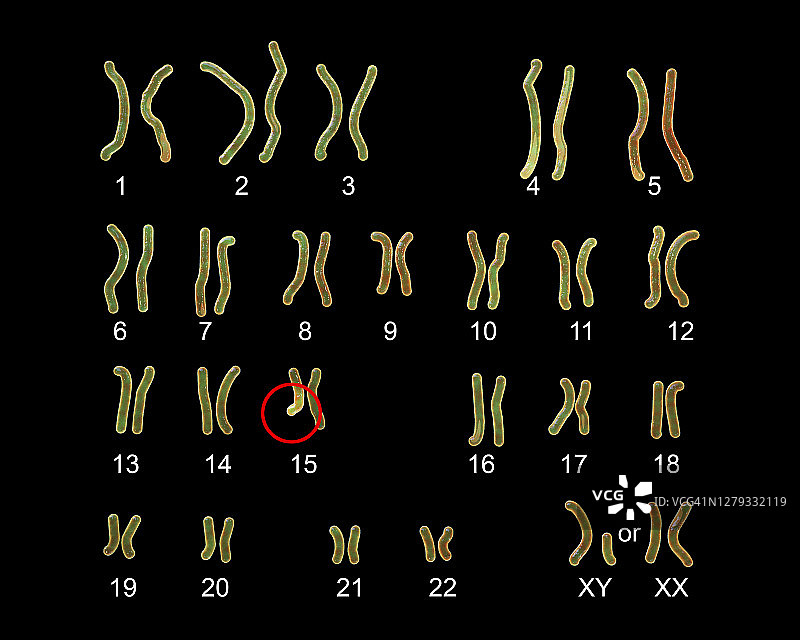 天使综合征的核型图图片素材