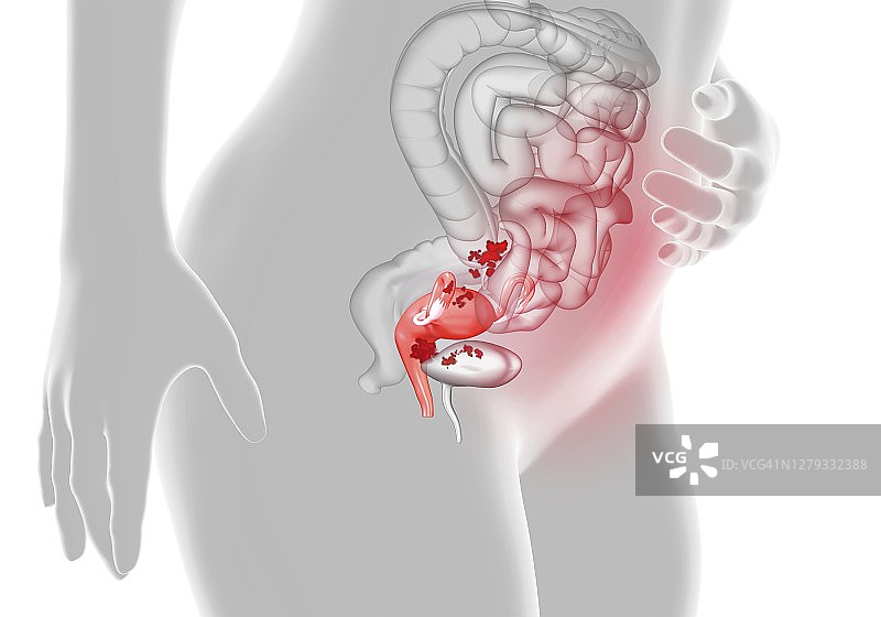 子宫内膜异位症图示图片素材