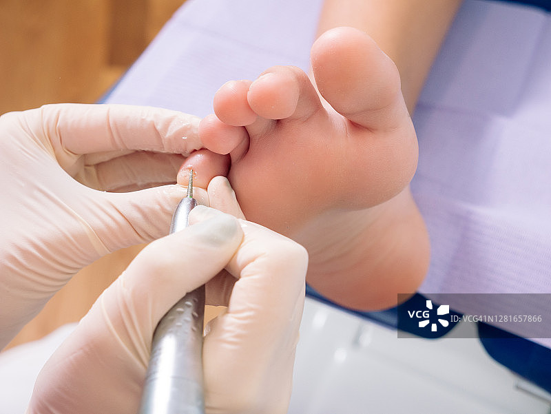 足病医生诊室里接受治疗的患者的脚图片素材