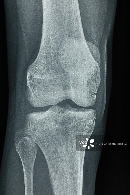 腿部损伤的骨科影像图片素材