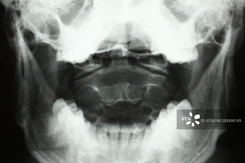 人颌和口腔区域的X光片图片素材