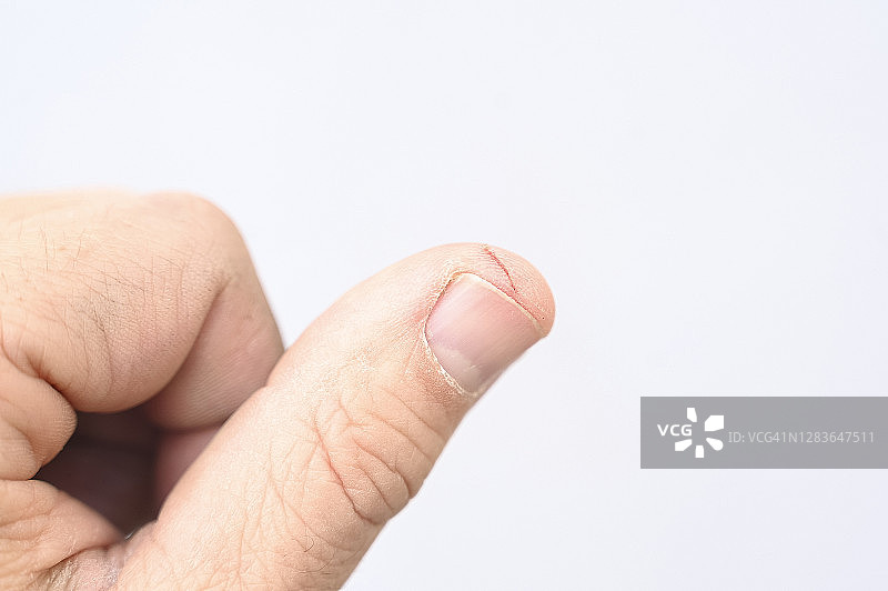 男人拇指内衬上的伤口特写图片素材