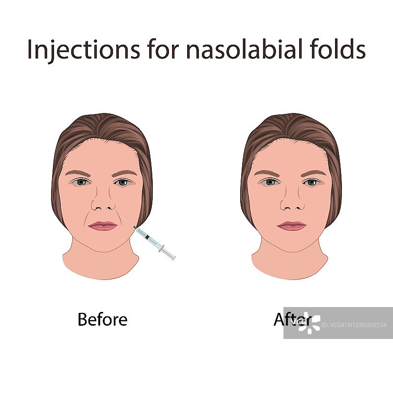 鼻唇沟注射图示图片素材
