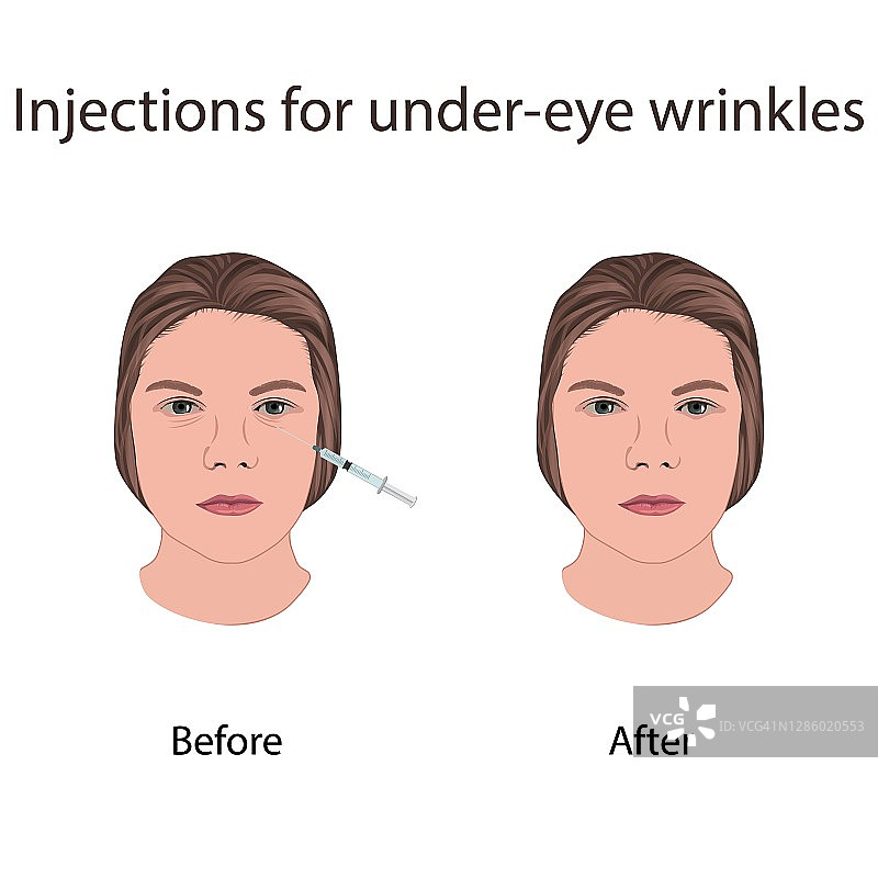 眼部除皱注射插画图片素材