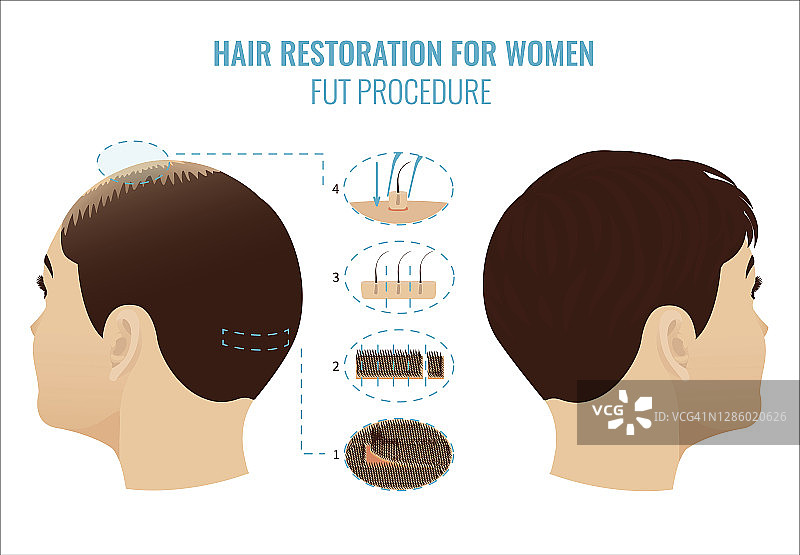 女性毛发移植治疗示意图图片素材