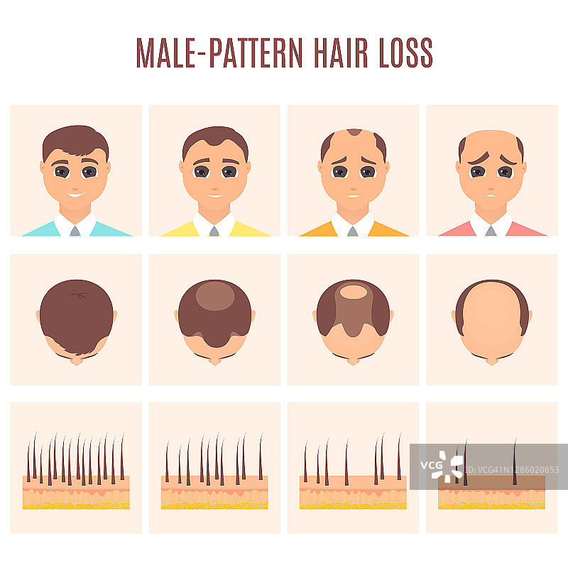 男性型脱发示意图图片素材