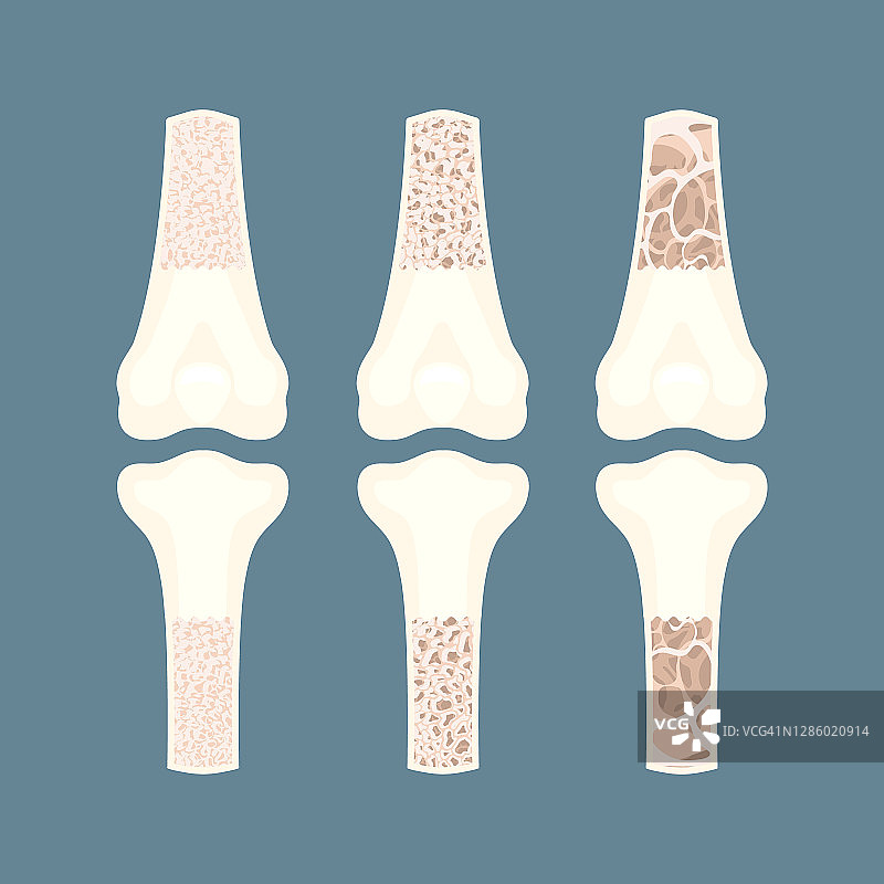 骨质疏松症宣传概念插画图片素材