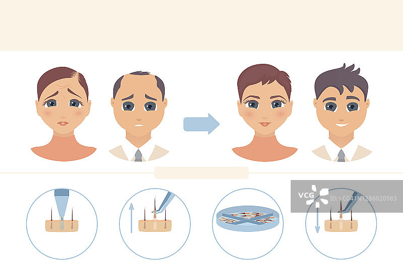 毛囊单位提取（FUE）头发移植概念图图片素材