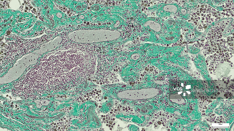 专业制备的乳腺导管癌组织切片的显微照片。图片素材