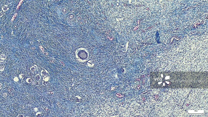 子宫肌瘤，也称为纤维瘤，子宫的良性平滑肌肿瘤，光学显微照片，显微镜下照片图片素材