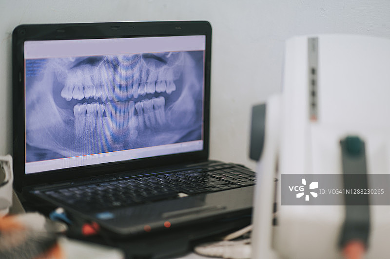 牙科诊所笔记本电脑上的X光屏幕图片素材
