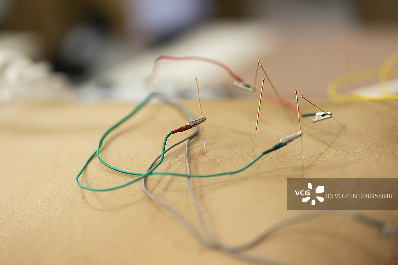 针灸疗法用针与接受针灸治疗的患者图片素材