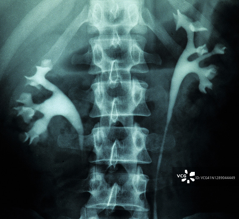 显示肾脏内部结构的X光片--静脉肾盂造影图片素材