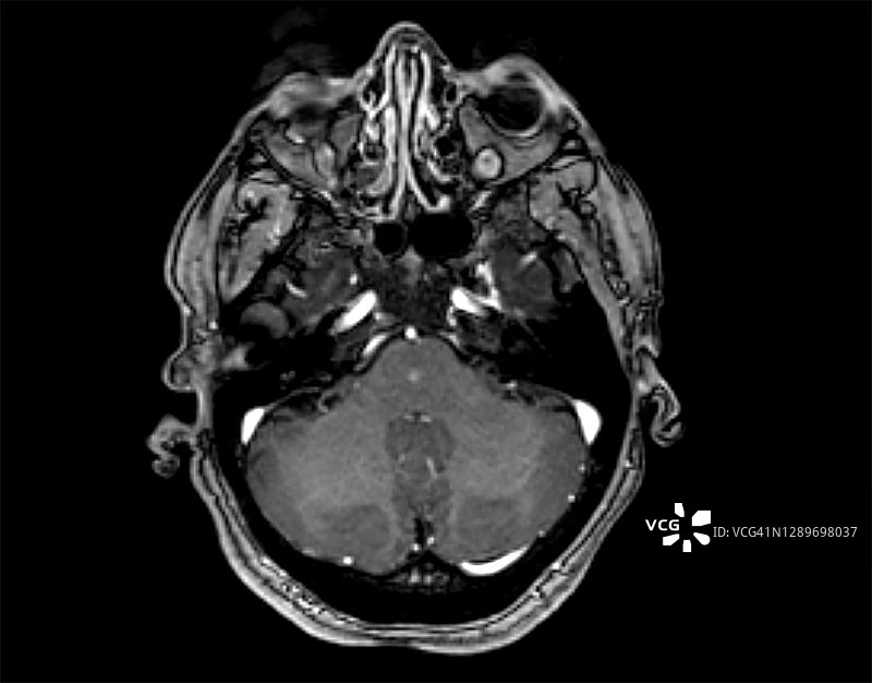 脑部MRI图像：脑桥毛细血管扩张图片素材