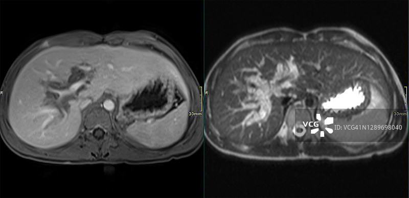神经纤维瘤病I型患儿肝脏丛状神经纤维瘤的MRI图片素材
