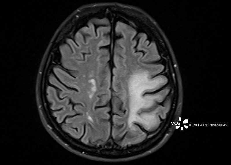 进行性多灶性白质脑病(PML)的MRI表现图片素材