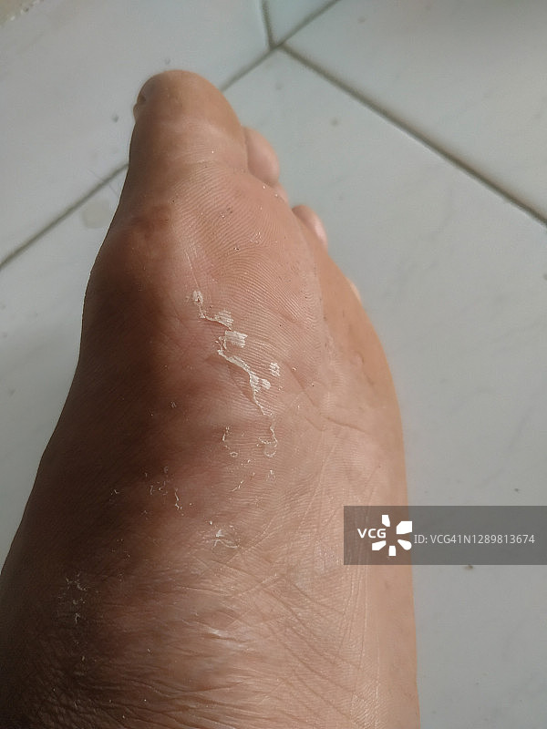因化学过敏反应而脱皮的男士脚部皮肤图片素材