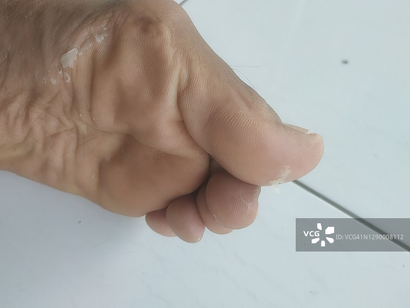 男子脚部皮肤因过敏化学反应而脱皮图片素材