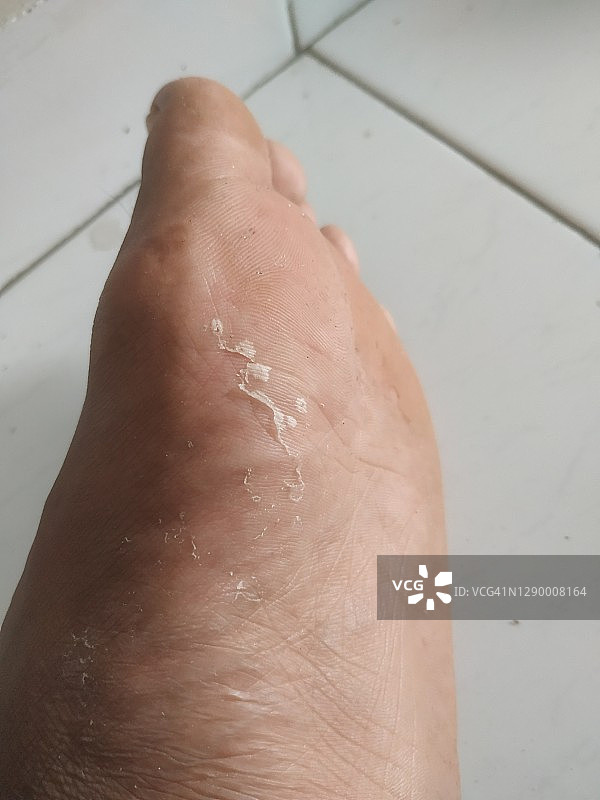 男子脚部皮肤因过敏化学反应而脱皮图片素材