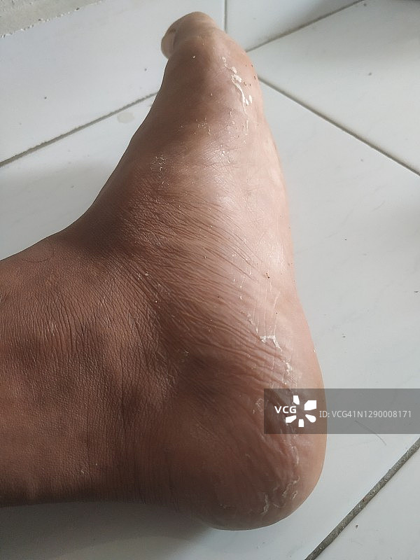 男子脚部皮肤因过敏化学反应而脱皮图片素材